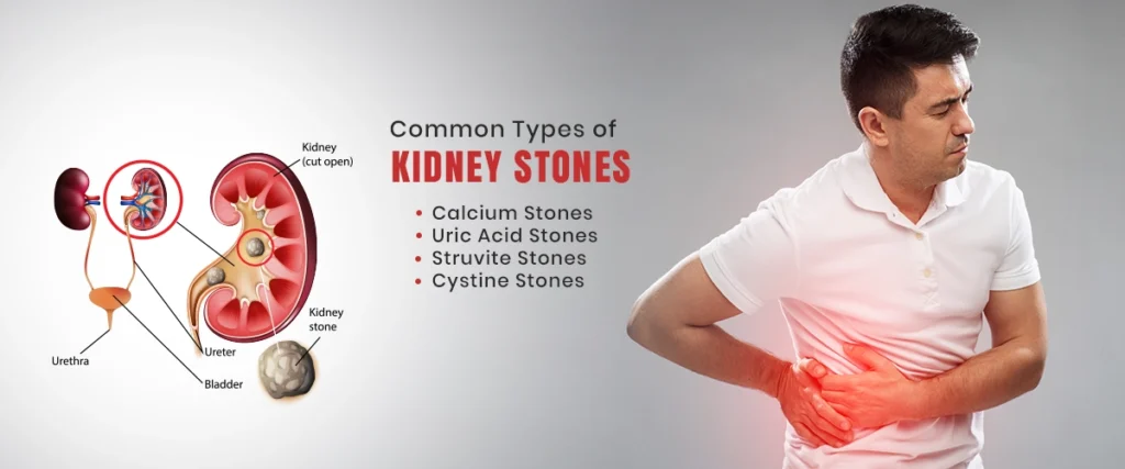 kidney stone blog 1 1