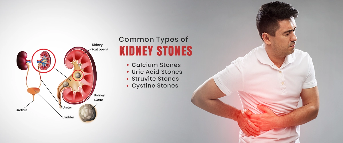 Common Types of Kidney stones