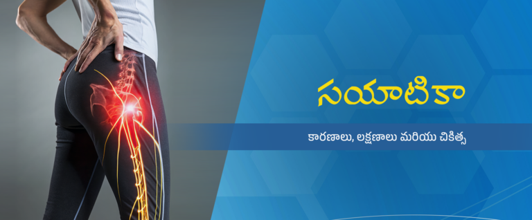 సయాటికా, కారణాలు, లక్షణాలు మరియు హోమియోపతి చికిత్స