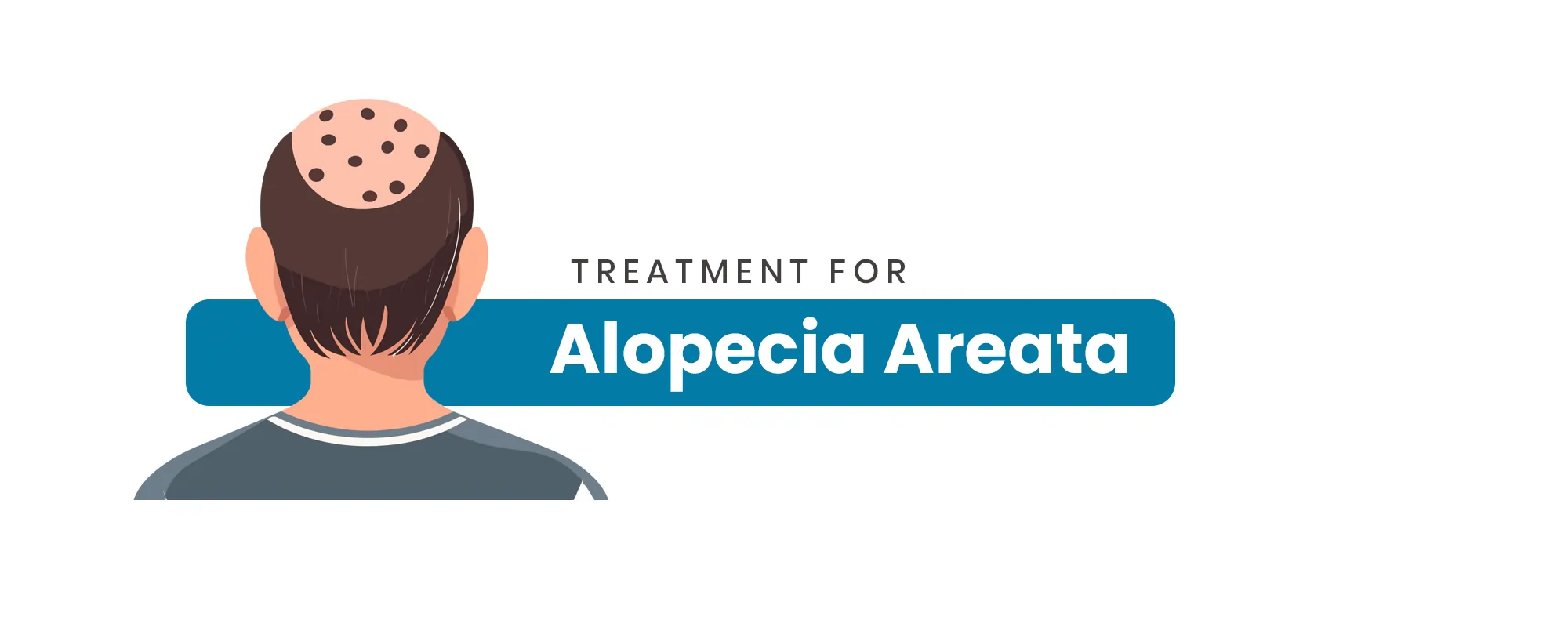 Alopecia-Areata