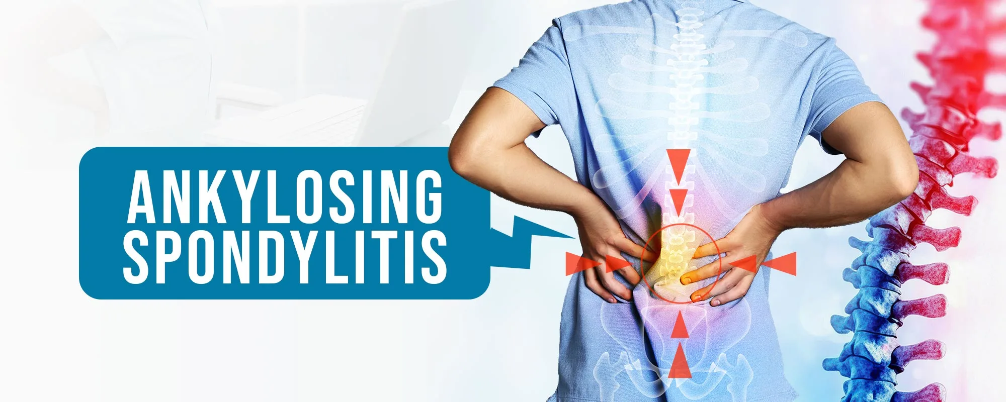 Ankylosing-Spondylitis