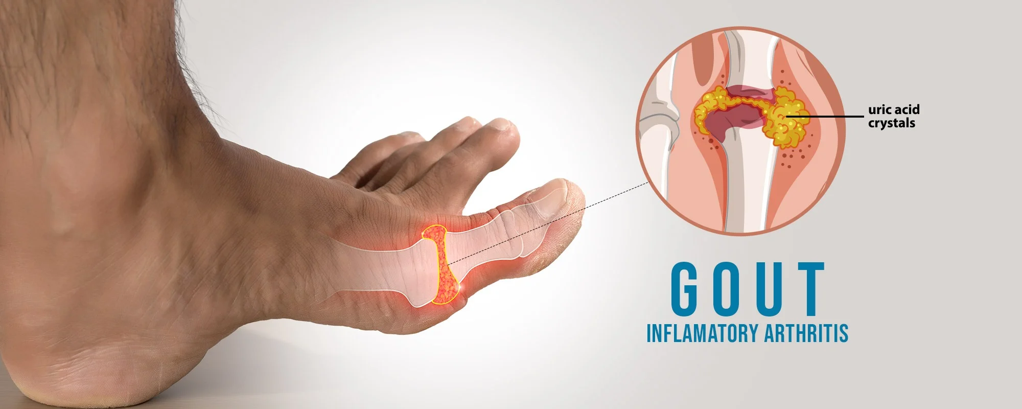 Gout-Treatments