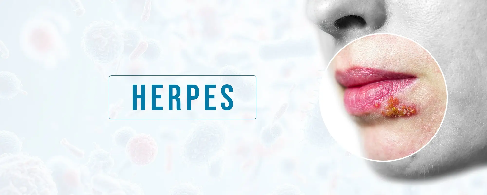 Herpes-Treatments-Banner