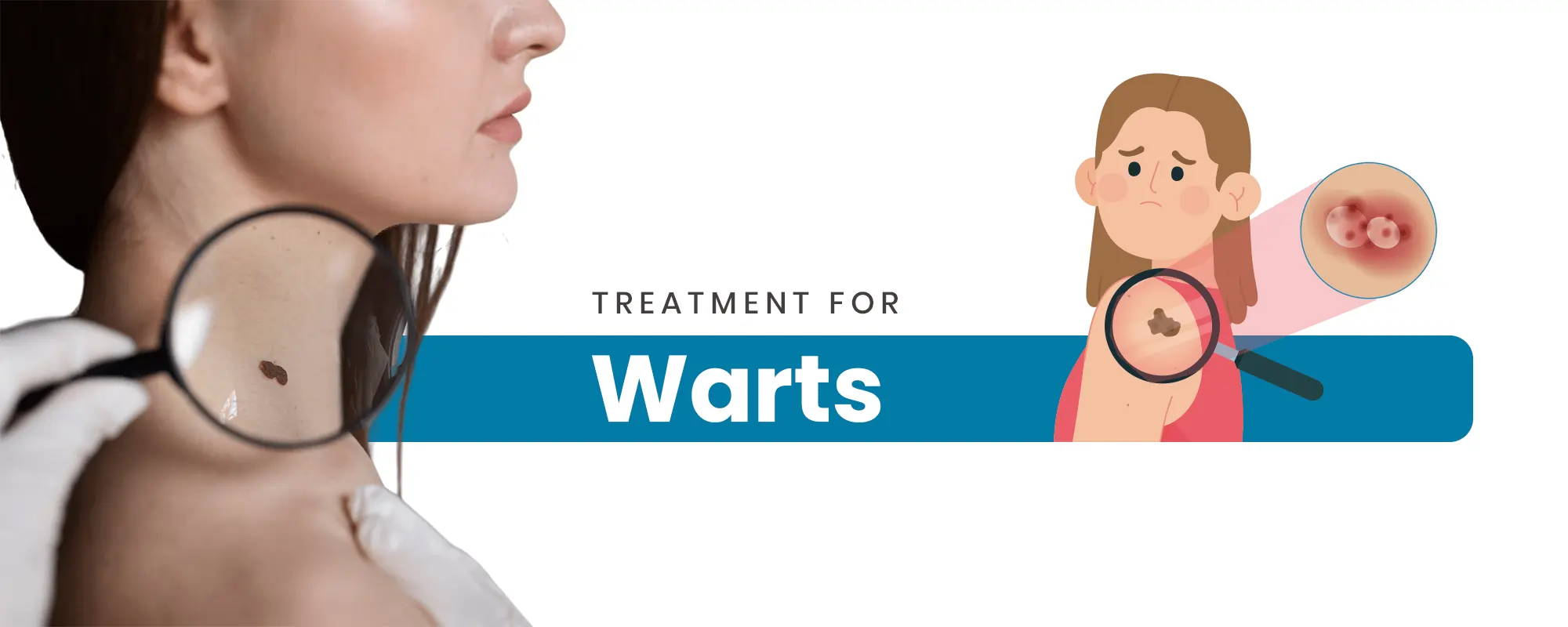 Warts-Treatment